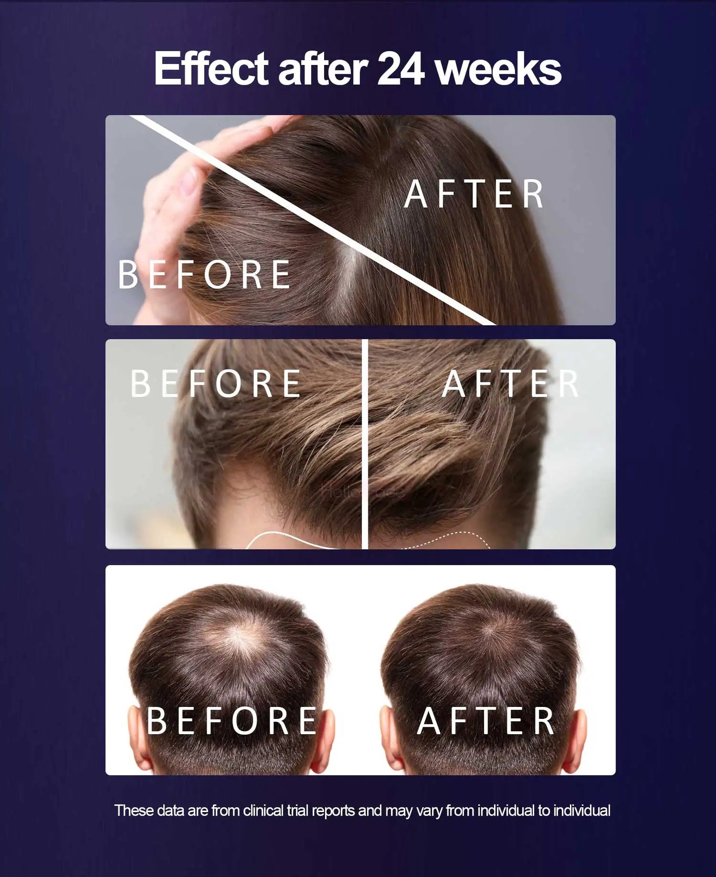 Dunclo Laser Hair Cap – Wissenschaftlich validiert. Sichtbar dichteres Haar.