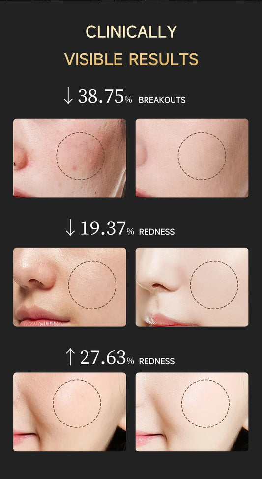 Dunclo LED Hautverjüngungsmaske - Professionelle Anti-Aging und Anti-Akne Lichttherapie für Zuhause