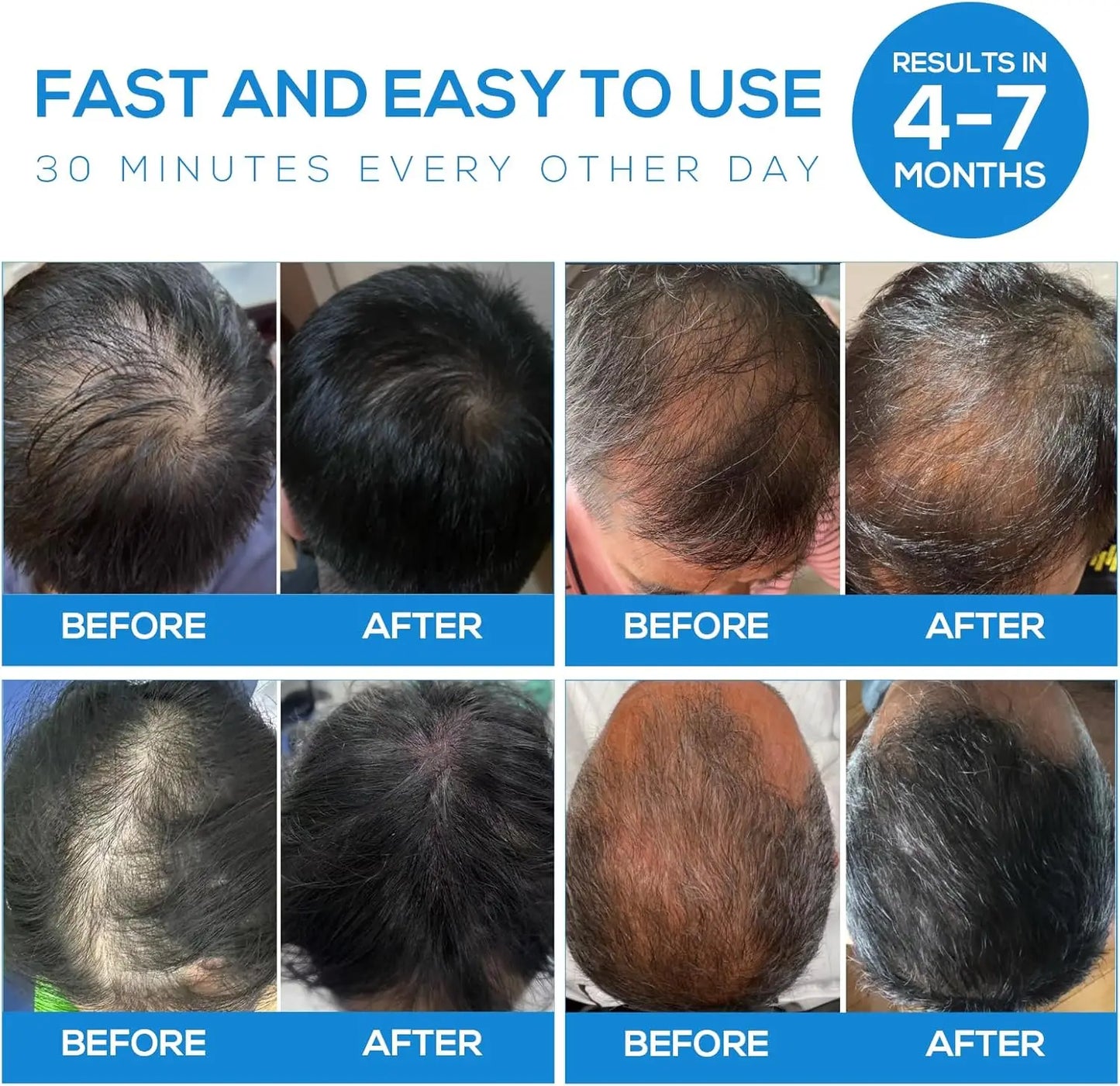 Dunclo Laser Hair Cap – Wissenschaftlich validiert. Sichtbar dichteres Haar.